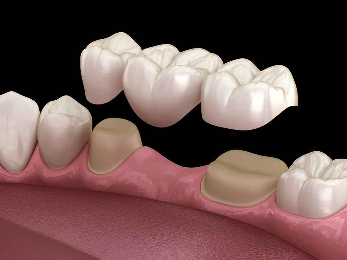 dental bridges near you
