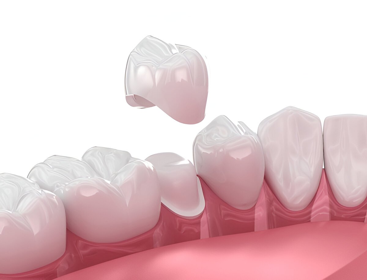 dental crowns in pickering
