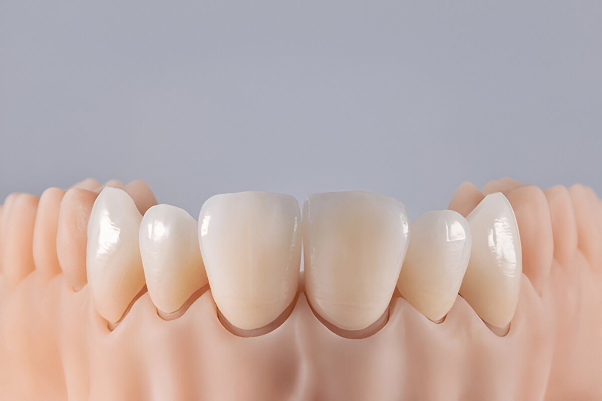 dental crowns near you