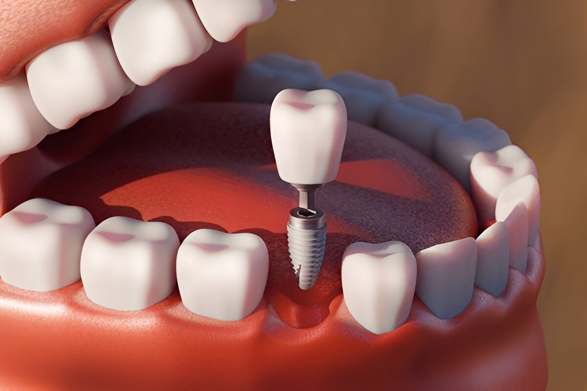 dental implants near you