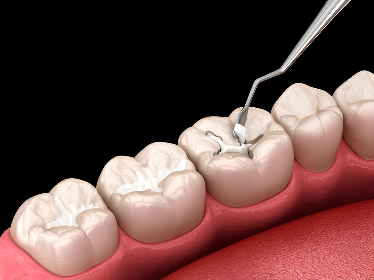 dental sealants near you