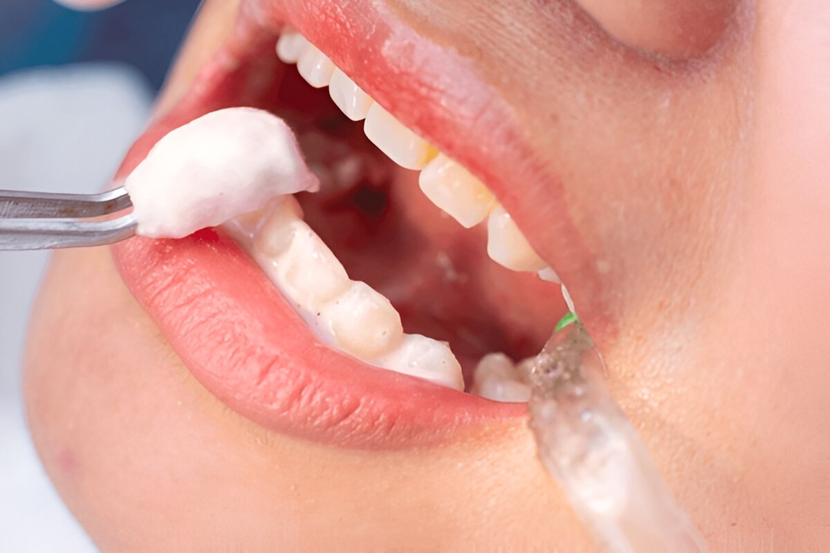 fluoride treatment near you