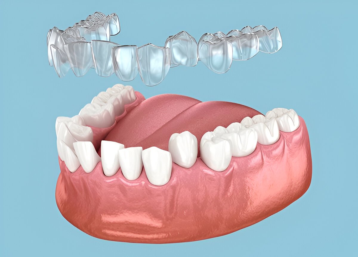 invisalign in pickering