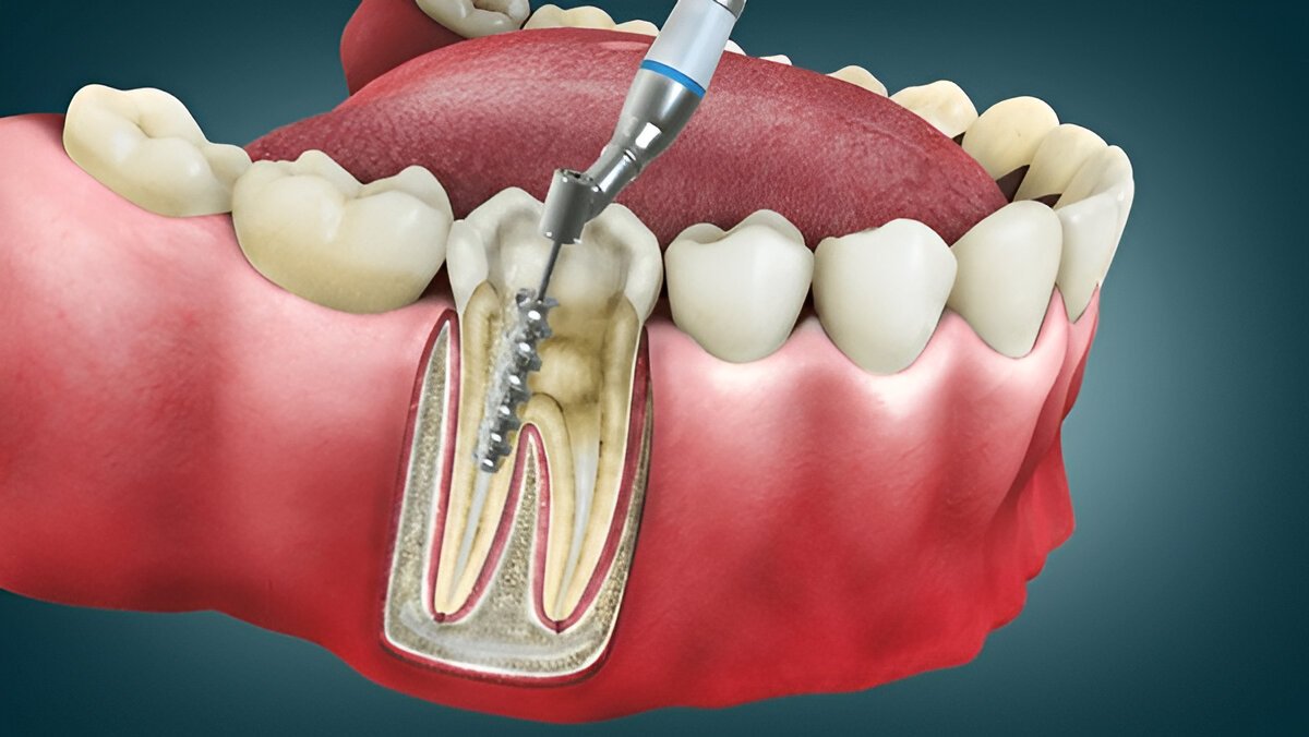 root canal therapy in pickering