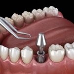 How Dental Implants Improve Jawbone Health Long-Term