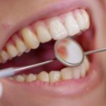 What Is Dental Bonding? A Complete 2026 Patient Guide